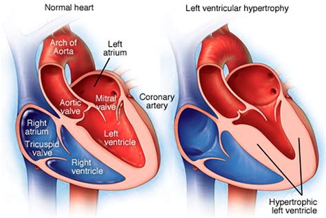 left ventricular hypertrophy symptoms.